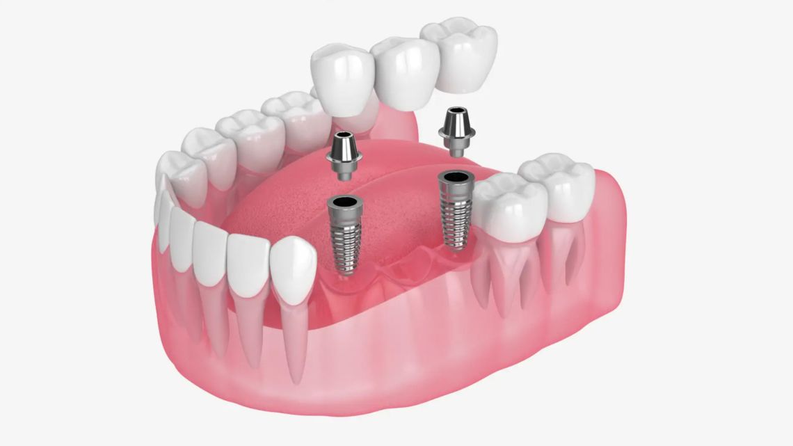 Dental Implants Event