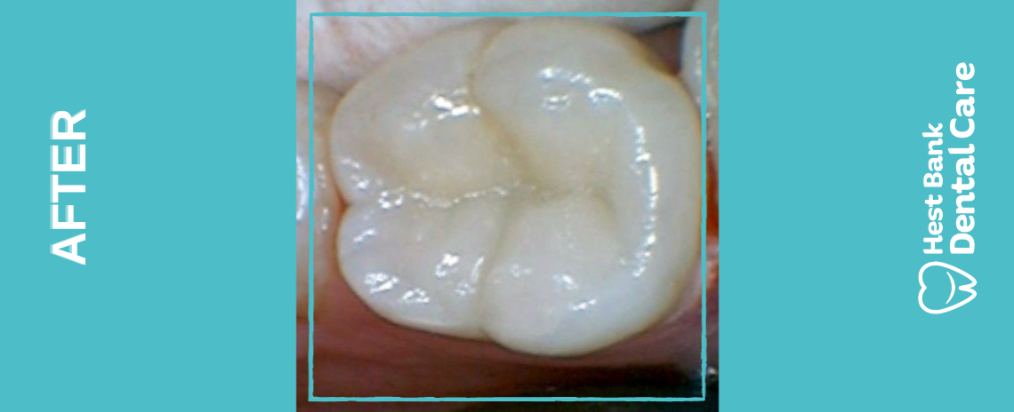 White fillings After