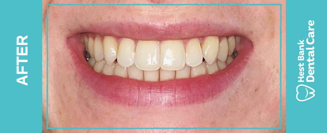 Invisalign After