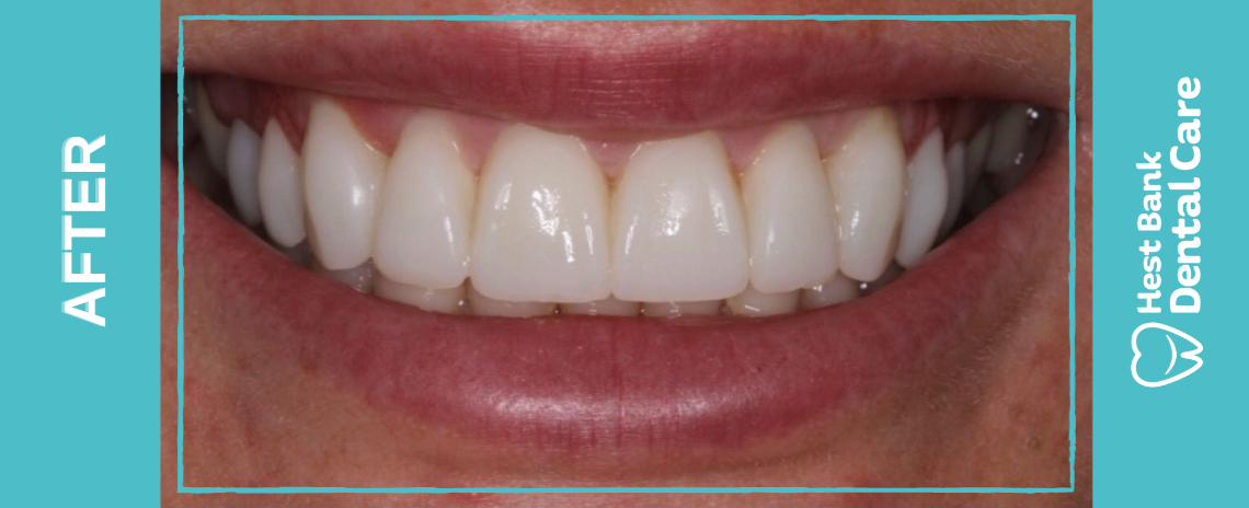 SmileFast After