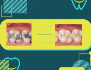 Composite fillings
