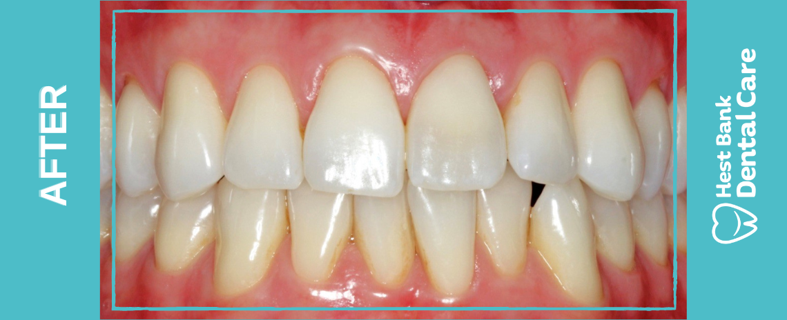 Veneer After