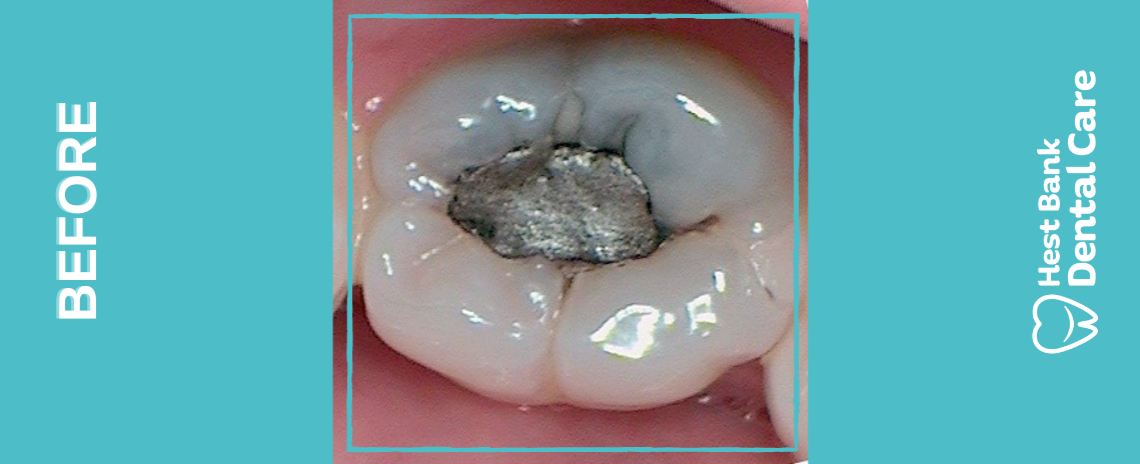 White fillings Before