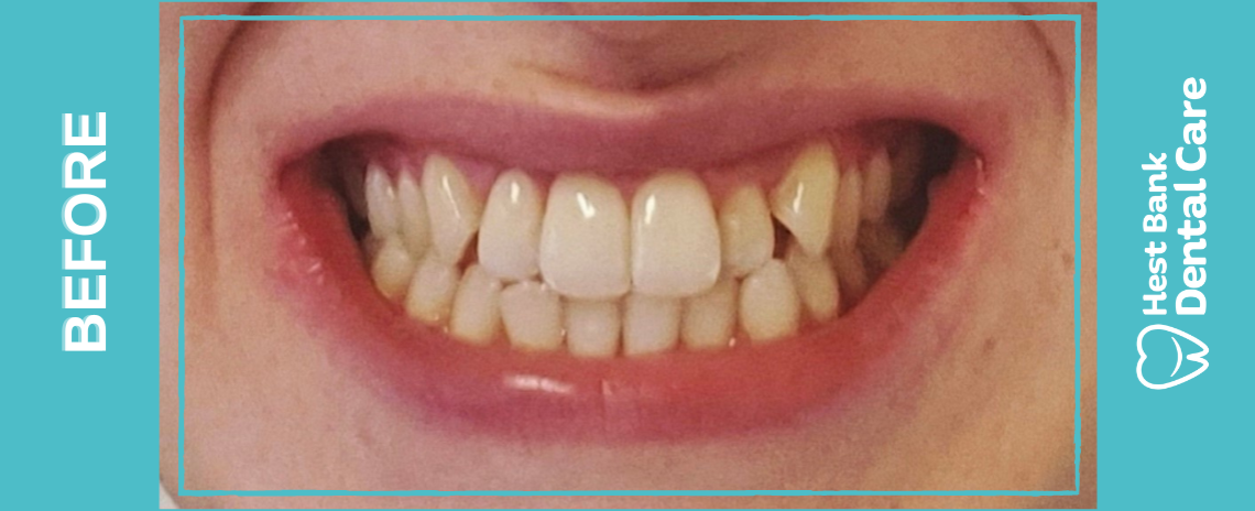 Invisalign Before