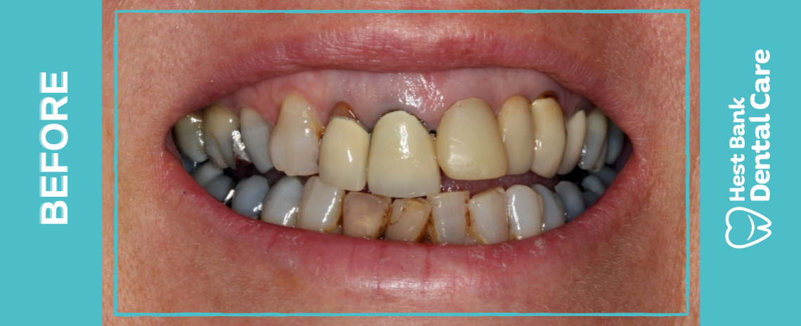 Replacement Bridge Before