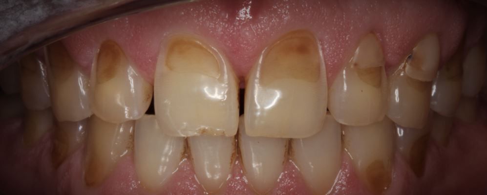 Dental Erosion