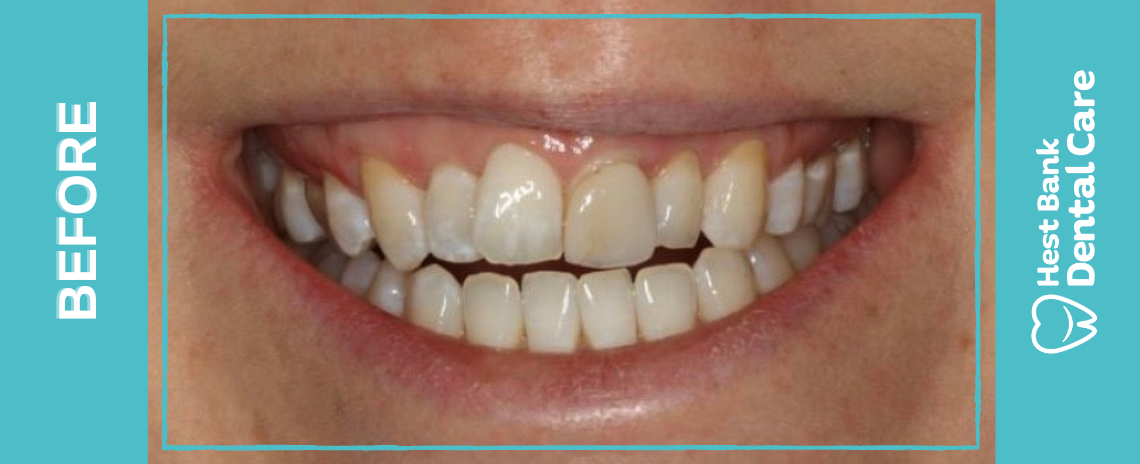 Replacement Veneer Before