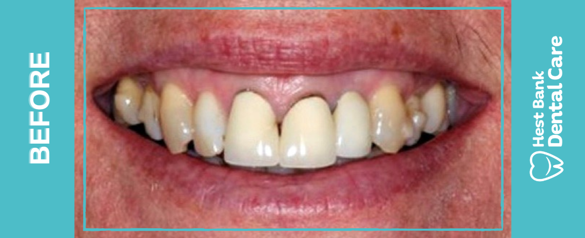 Crowns | Emax Before