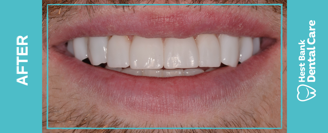 SmileFast After