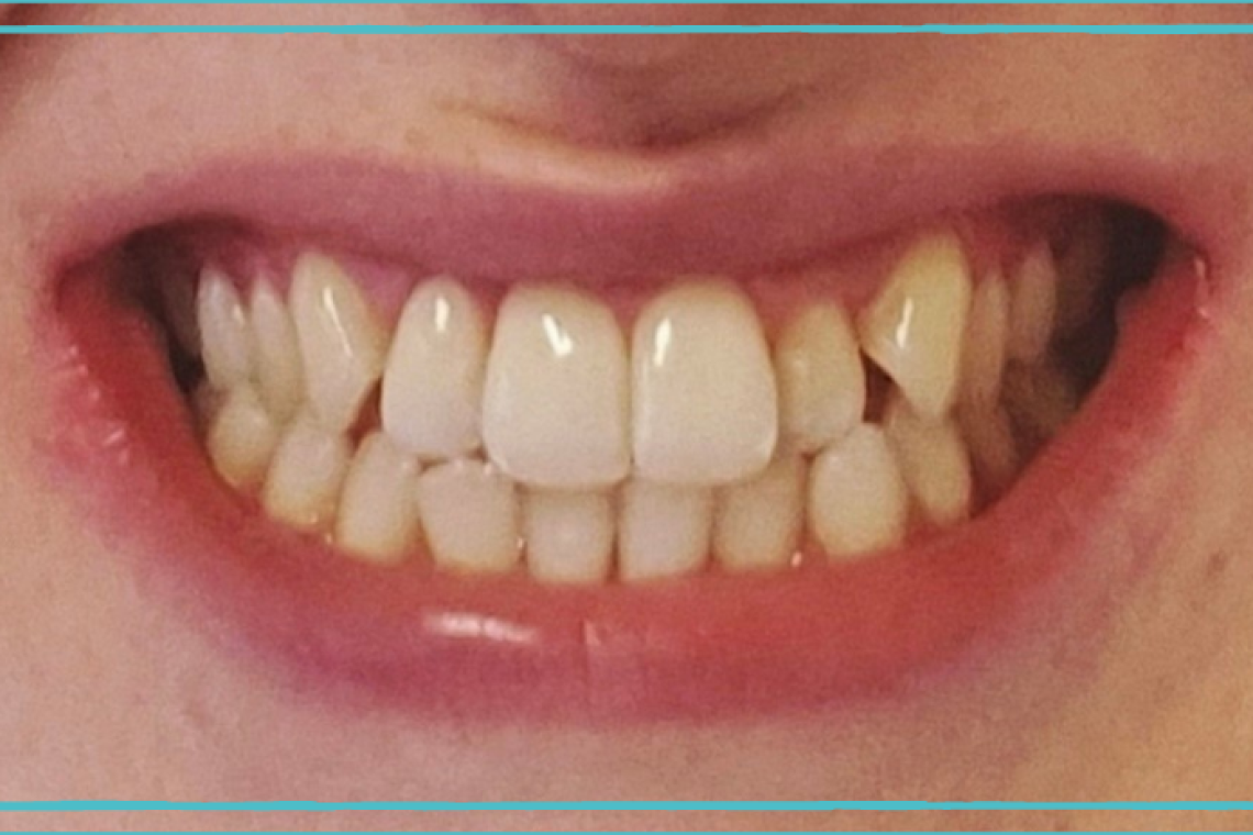 Invisalign before