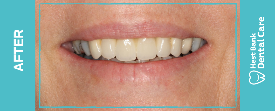 Replacement Bridge After