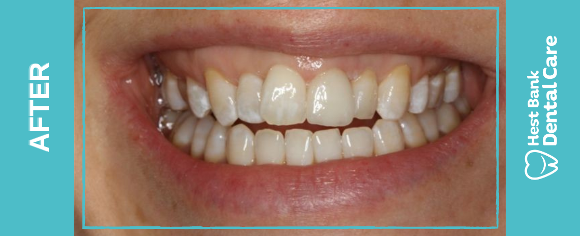 Replacement Veneer After
