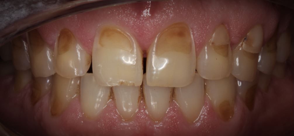 Dental Erosion