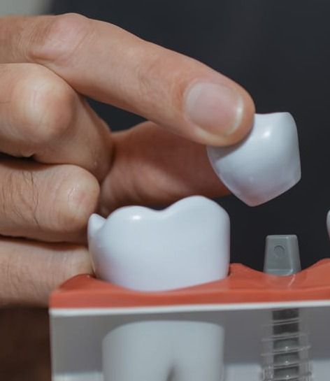 Clinician placing a crown onto a dental implant model