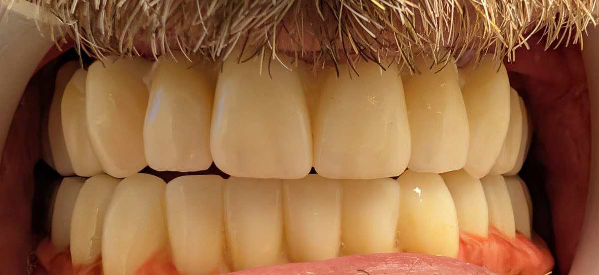 Close up of fixed full arch implant teeth after treatment