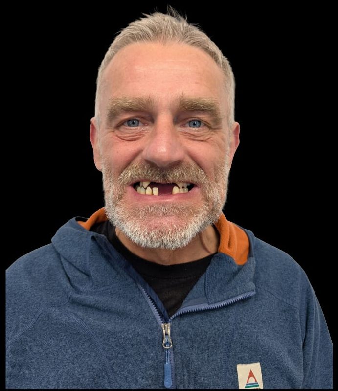 Patient before All on 4 dental implants at Hest Bank Dental Care, Lancaster